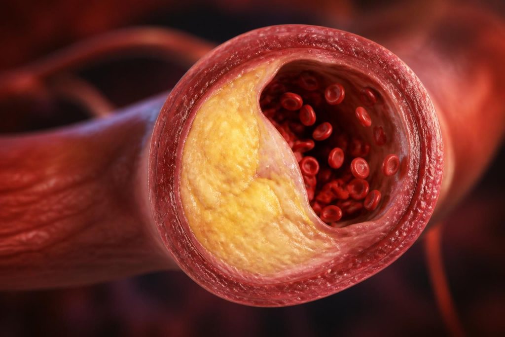 Arterin cholesterol : comprendre son rôle dans la santé cardiovasculaire